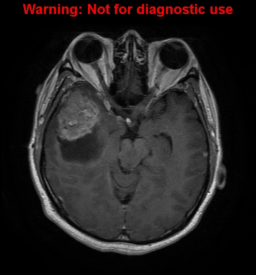 File:Anaplastic ganglioglioma (Radiopaedia 44921-48831 Axial T1 C+ 12).jpg