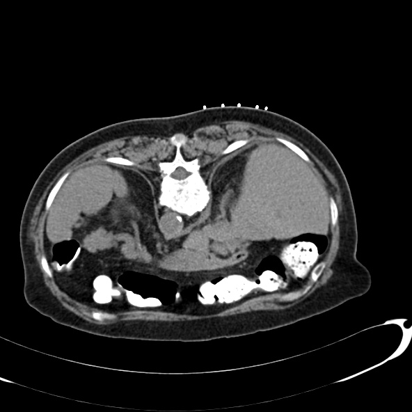 File:Anaplastic lymphoma - with CT biopsy (Radiopaedia 21643-21602 Axial non-contrast 8).jpg