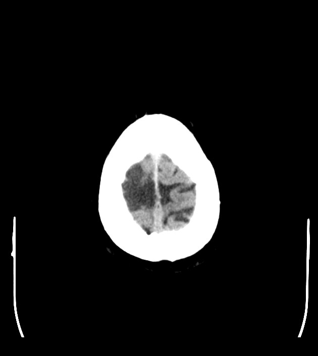 Anaplastic oligodendroglioma (Radiopaedia 79571-92753 Axial non-contrast 49).jpg