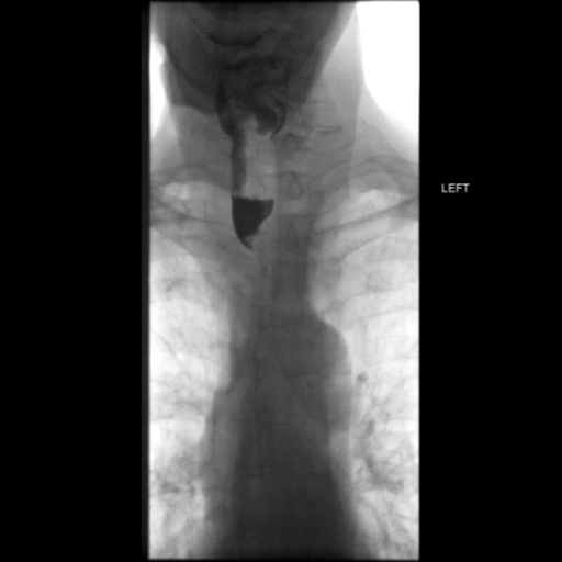 File:Anastomotic stricture post Ivor Lewis esophagectomy (Radiopaedia 47937-52715 Frontal 8).png