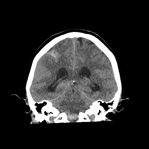 Aneursym related subarachnoid hemorrhage with hydrocephalus (Radiopaedia 45105-49083 Coronal non-contrast 41).jpg
