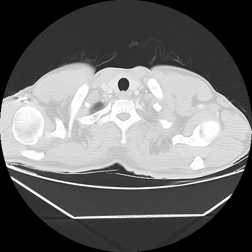 Aneurysmal bone cyst - rib (Radiopaedia 82167-96220 Axial lung window 10).jpg