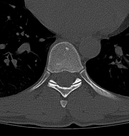 Aneurysmal bone cyst T11 (Radiopaedia 29294-29721 Axial bone window 17).jpg
