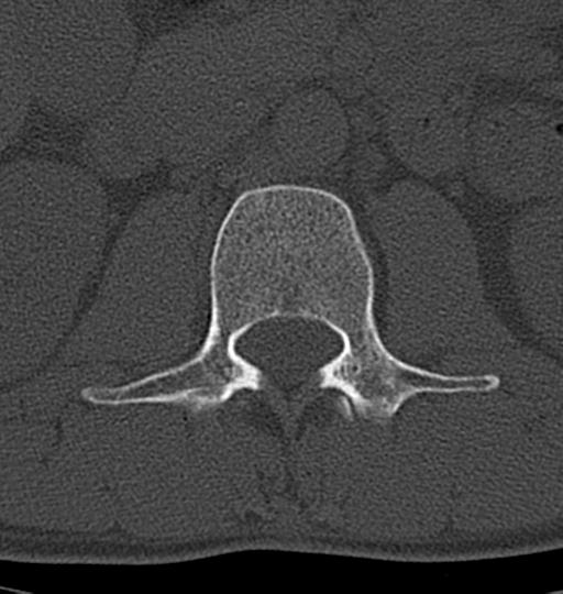 Aneurysmal bone cyst T11 (Radiopaedia 29294-29721 Axial bone window 75).jpg