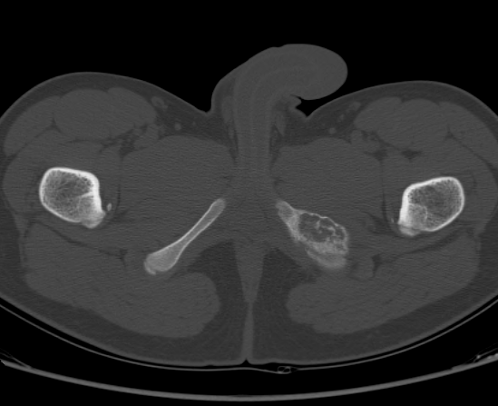 File:Aneurysmal bone cyst of ischium (Radiopaedia 25957-26094 Axial bone window 79).png