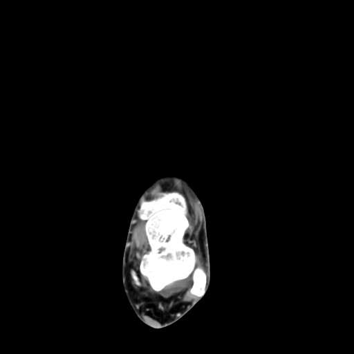 File:Aneurysmal bone cyst of the calcaneus (Radiopaedia 60669-68421 A 21).jpg