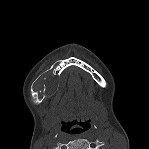 File:Aneurysmal bone cyst of the mandible (Radiopaedia 43280-46601 Axial bone window 10).jpg