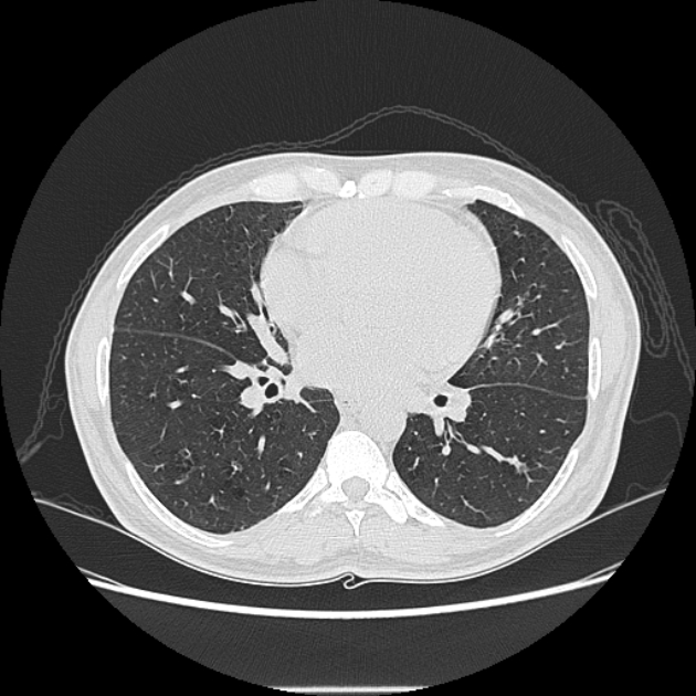 Angioinvasive aspergellosis (Radiopaedia 66995-76315 Axial lung window 29).jpg