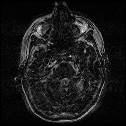 Angioinvasive aspergillosis in the pituitary fossa (Radiopaedia 39676-42010 Ax 3D FIESTA VOLUME 31).png