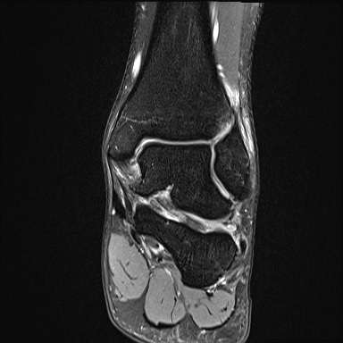 Ankle syndesmotic injury (Radiopaedia 69066-78837 Coronal PD fat sat 31).jpg