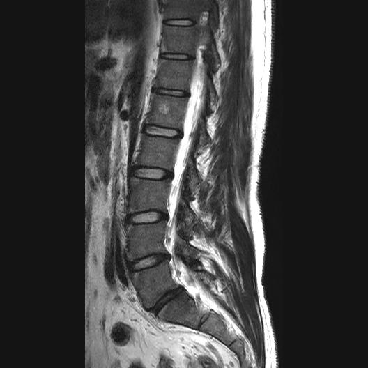 File:Ankylosing spondylitis with zygapophyseal arthritis (Radiopaedia 38433-40516 Sagittal T2 7).jpg