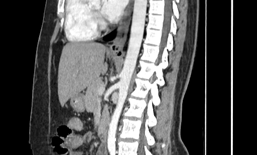 Annular pancreas (Radiopaedia 70359-80453 B 33).jpg