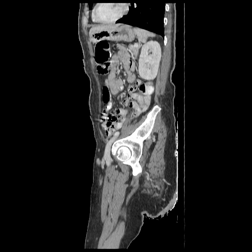 Anorectal carcinoma (Radiopaedia 44413-48064 C 80).jpg
