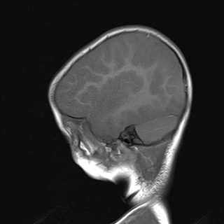 File:Anoxic brain injury (Radiopaedia 79165-92139 Sagittal T1 16).jpg