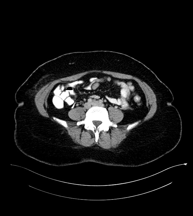Anterior abdominal wall CSF pseudocyst (CSFoma) (Radiopaedia 79453-92571 A 60).jpg