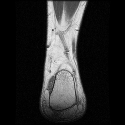 File:Anterior calcaneal process fracture (Radiopaedia 74654-85611 Coronal T1 23).jpg