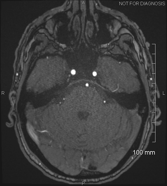 Anterior cerebral artery aneurysm (Radiopaedia 80683-94127 Axial MRA 65).jpg