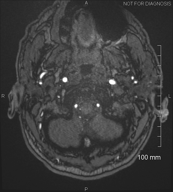 Anterior cerebral artery aneurysm (Radiopaedia 80683-94127 Axial MRA 7).jpg
