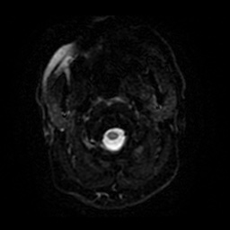 Anterior cerebral artery infarction (Radiopaedia 46794-51323 Axial DWI 29).jpg