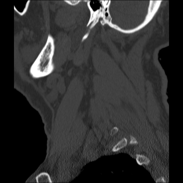 Anterior cervical postdiscectomy arthrodesis (Radiopaedia 32678-33646 Sagittal bone window 74).jpg