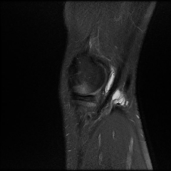 File:Anterior cruciate ligament graft tear and bucket-handle tear of medial meniscus (Radiopaedia 75867-87254 Sagittal PD fat sat 4).jpg