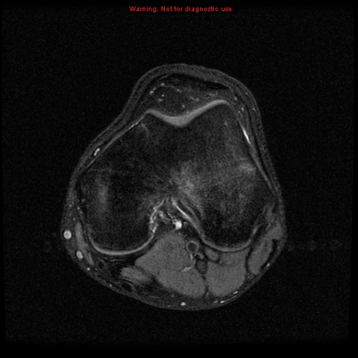 File:Anterior cruciate ligament injury - partial thickness tear (Radiopaedia 12176-12515 Axial PD 12).jpg