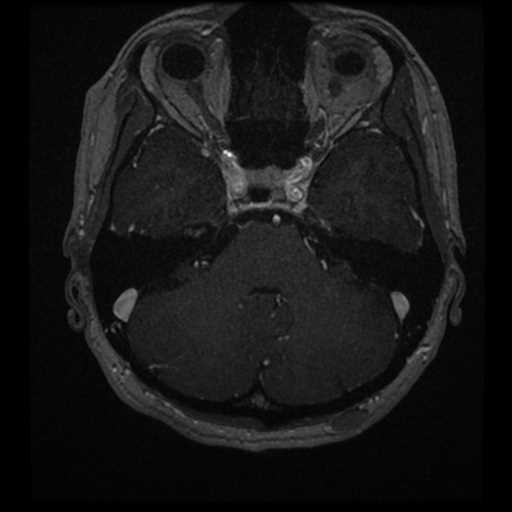 Anterior inferior cerebellar artery vascular loop - type II (Radiopaedia 70991-81209 Axial T1 C+ 39).jpg