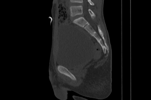 Anterior inferior iliac spine avulsion injury (Radiopaedia 88666-105376 Sagittal bone window 49).jpg