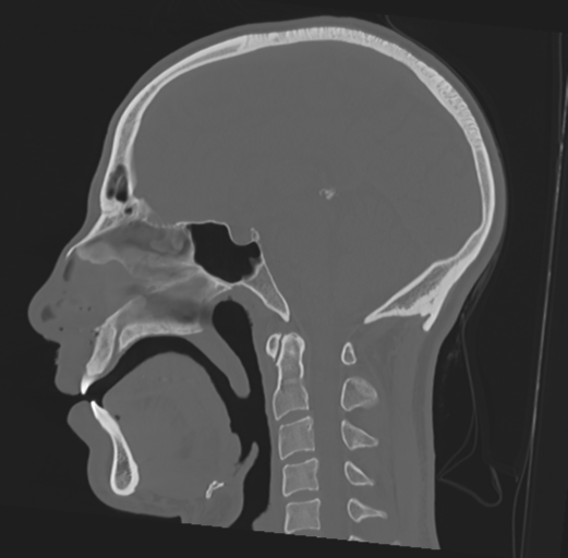 File:Anterior nasal spine fracture (Radiopaedia 46138-50494 Sagittal bone window 29).png