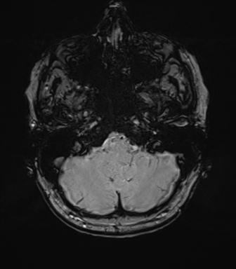 Anterior temporal lobe perivascular space (Radiopaedia 40946-43650 Axial SWI 15).png