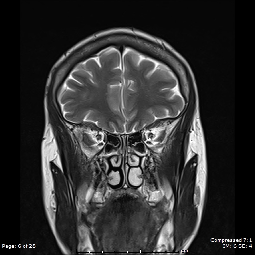 File:Anterior temporal lobe perivascular space (Radiopaedia 88283-104914 Coronal T2 6).jpg