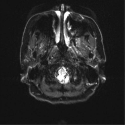 Anterior temporal pole cysts (Radiopaedia 46629-51102 Axial DWI 2).png