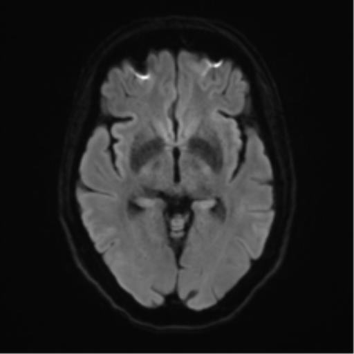 Anterior temporal pole cysts (Radiopaedia 46629-51102 Axial DWI 40).png