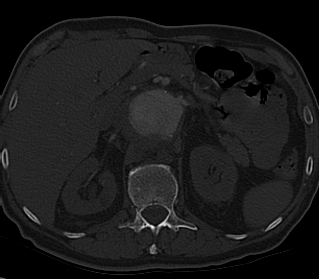 File:Anterior vertebral scalloping (abdominal aortic aneurysm) (Radiopaedia 66744-76067 Axial bone window 35).jpg