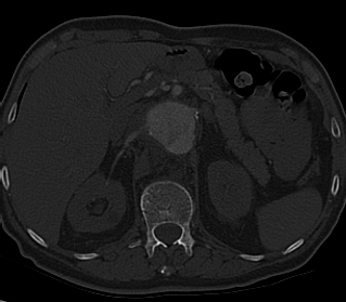 File:Anterior vertebral scalloping (abdominal aortic aneurysm) (Radiopaedia 66744-76067 Axial bone window 37).jpg