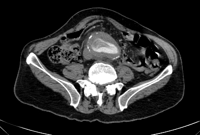 Anterior vertebral scalloping (abdominal aortic aneurysm) (Radiopaedia 66744-76067 F 62).jpg