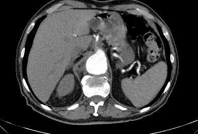 Anterior vertebral scalloping (abdominal aortic aneurysm) (Radiopaedia 66744-76067 F 7).jpg