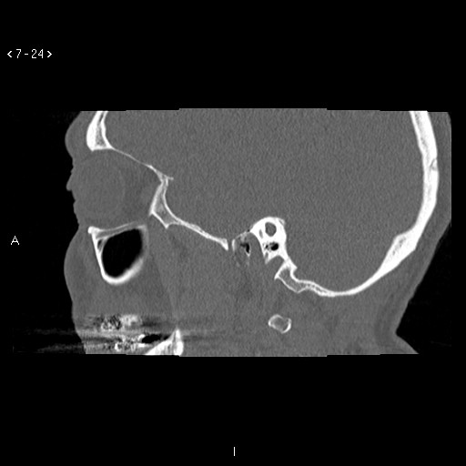 File:Antrochoanal Polyp (Radiopaedia 70510-80631 Sagittal bone window 14).jpg
