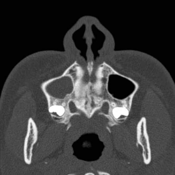 Antrochoanal polyp (Radiopaedia 33984-35202 Axial bone window 9).jpg