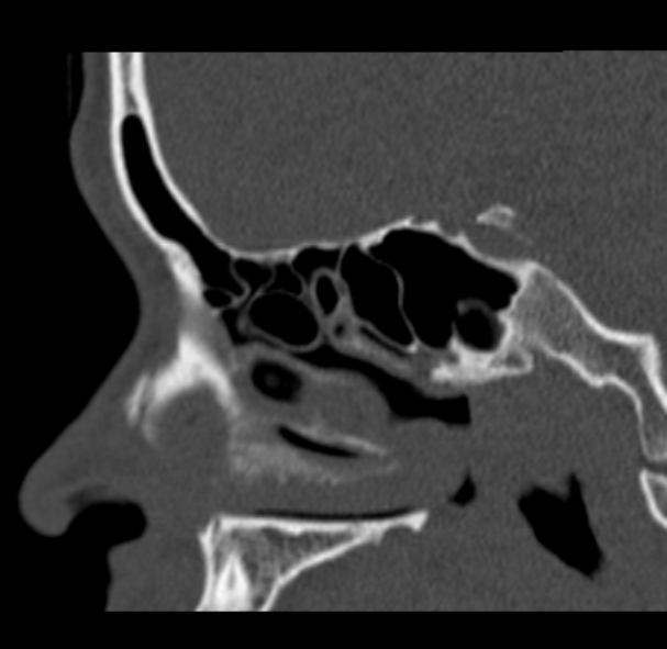 Antrochoanal polyp (Radiopaedia 33984-35202 Sagittal bone window 33).jpg