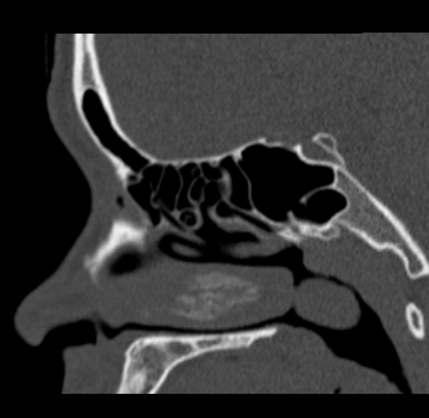 Antrochoanal polyp (Radiopaedia 33984-35202 Sagittal bone window 48).jpg