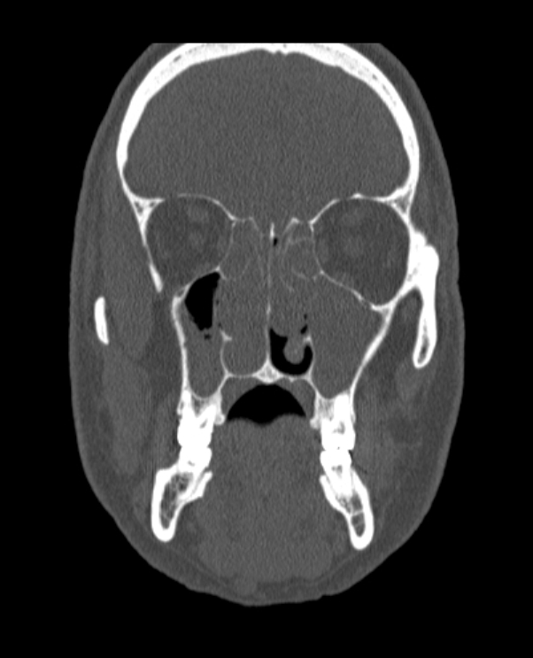 Antrochoanal polyp (Radiopaedia 79011-92169 Coronal bone window 47).jpg