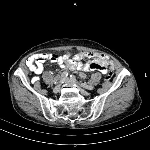 Aortic aneurysm and Lemmel syndrome (Radiopaedia 86499-102554 Axial C+ delayed 58).jpg