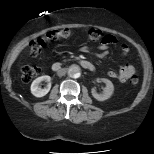 File:Aortic aneurysm and dissection - Stanford type A (Radiopaedia 36693-38261 A 61).png