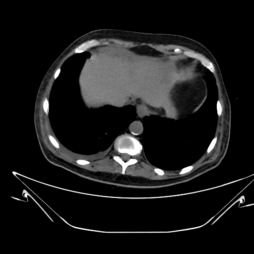 Aortic arch aneurysm (Radiopaedia 84109-99365 Axial non-contrast 235).jpg