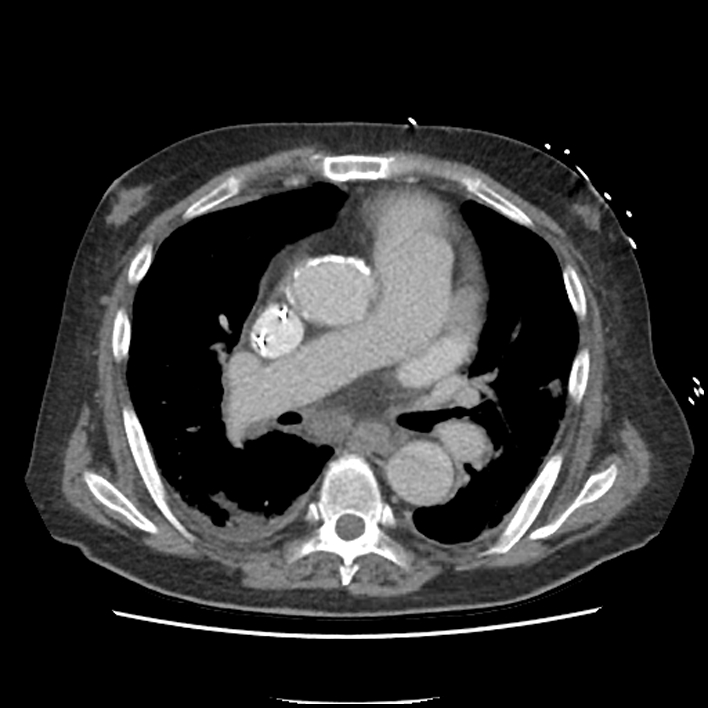 Aortic arch graft infection (FDG PET-CT) (Radiopaedia 71975-82437 A 27).jpg