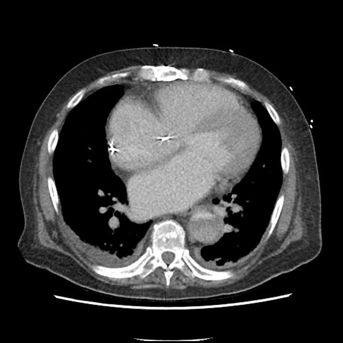 Aortic arch graft infection (FDG PET-CT) (Radiopaedia 71975-82437 A 37).jpg
