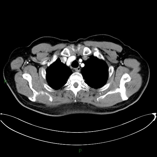 File:Aortic arch origin of left vertebral artery (Radiopaedia 46327-50737 Axial post contrast 20).jpg