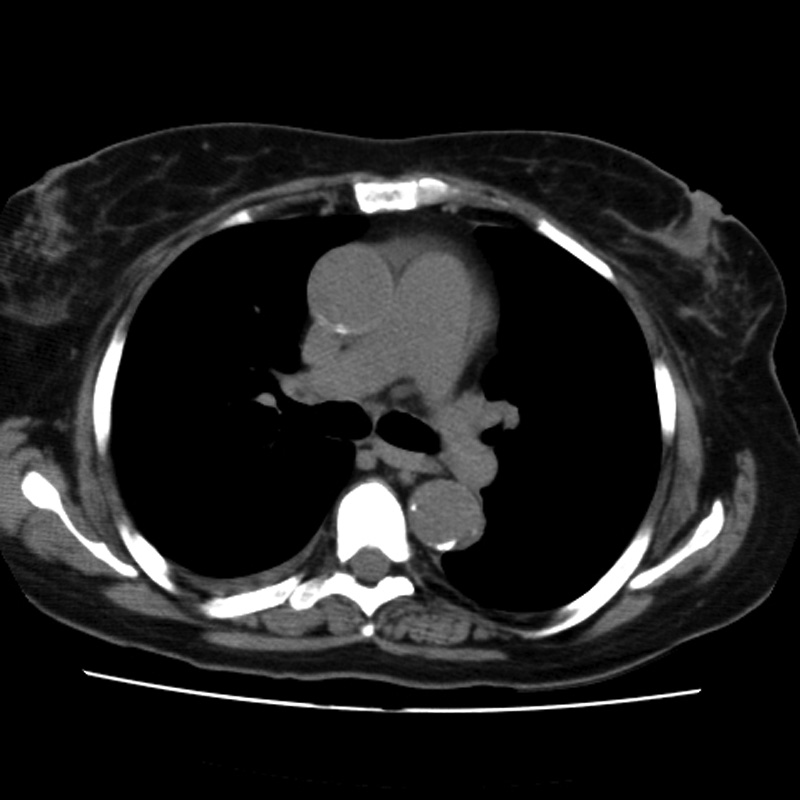 Aortic arch pseudoaneurysm (Radiopaedia 8534-9368 Axial non-contrast 32).jpg