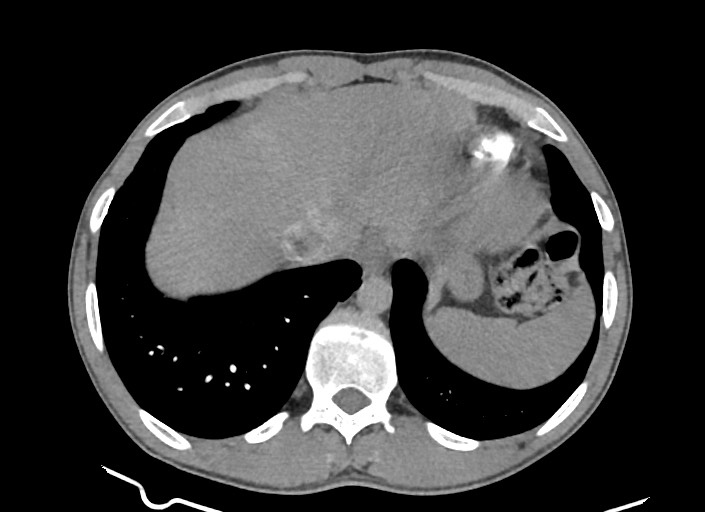 File:Aortic coarctation with aneurysm (Radiopaedia 74818-85828 A 51).jpg